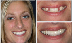 extreme makeover before and after teeth