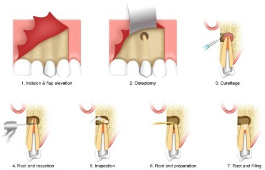 Precision dentistry: advancements in apical microsurgery